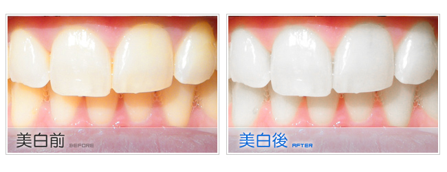 「牙齒美白」的圖片搜尋結果