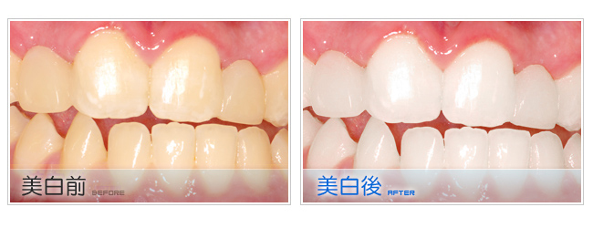 牙齒矯正居家美白和雷射美白有何不同？