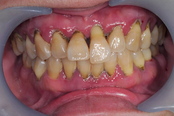 牙周病初期治療（無手術，治療前）