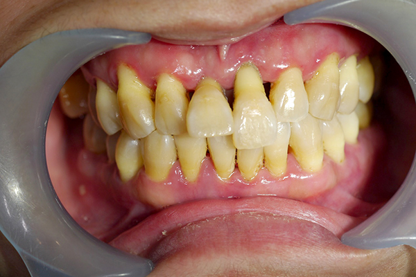 牙周病初期治療（無手術，治療後）