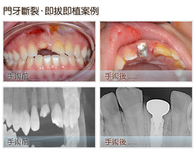 植牙案例