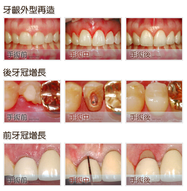 植牙外型再造